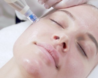 Microneedlingansigtsbehandlinginklaftercarest-20